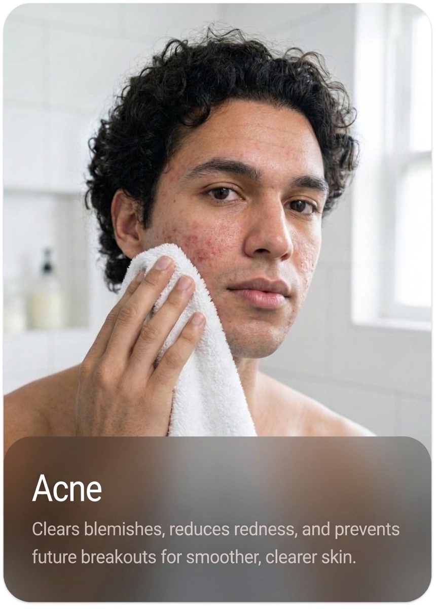 Acne Skin